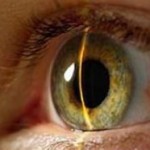 Ангиопатия - глазное заболевание.