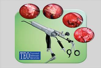 MEDIA 15893 PRO Яркие факты TEO® Трансанальная эндоскопическая операция Рис. 01